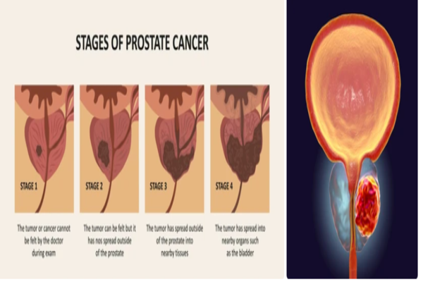 مراحل سرطان البروستاتا 