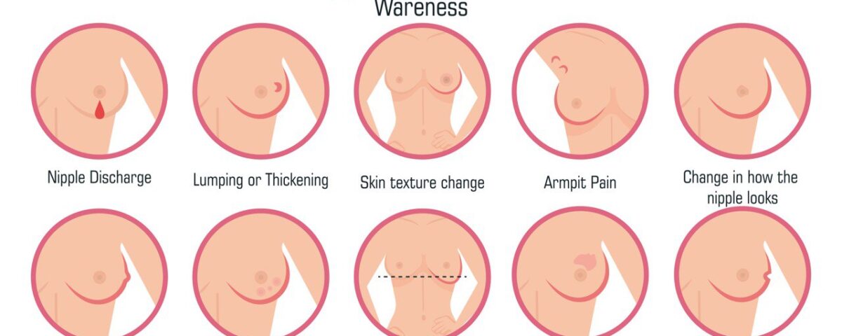 سرطان الثدي الخبيث ومراحله