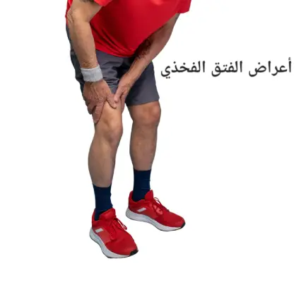 أعراض الفتق الفخذي