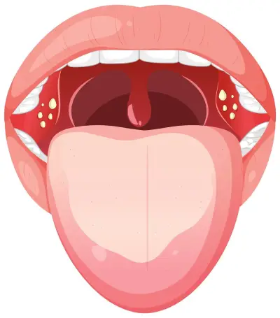 اعراض سرطان الفم واللسان