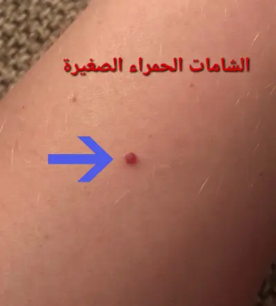 الشامات الحمراء الصغيرة